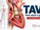 tavi